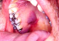 Kaposi's Sarcoma